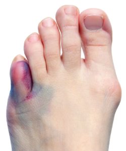 Foot with bunion on big toe joint