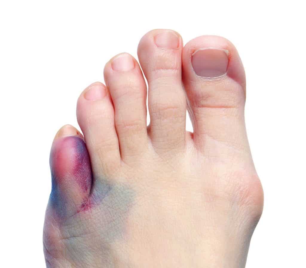 Foot with bunion and bruising