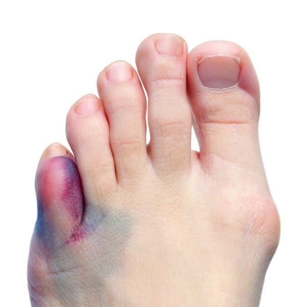 Foot with bunion and bruising
