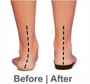 Pronated flat feet image before and after orthotic support