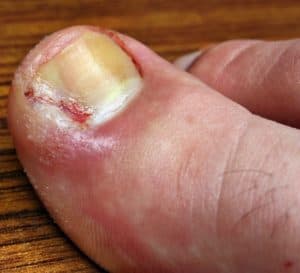 infected ingrown toenail single edge