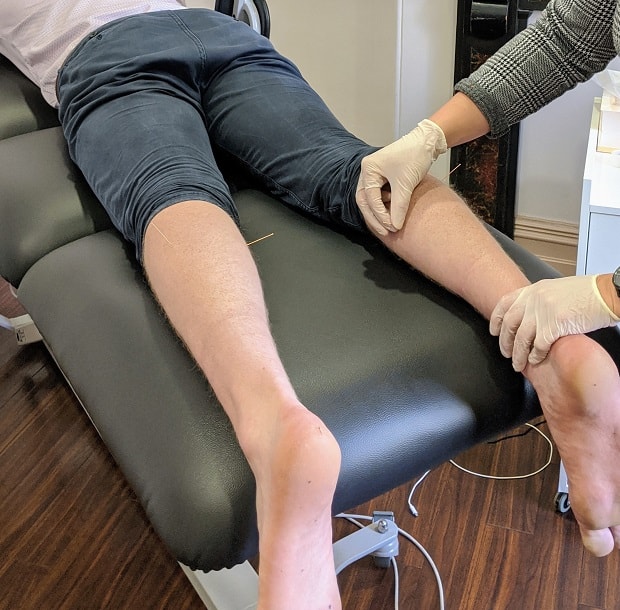 Does dry needling actually work?