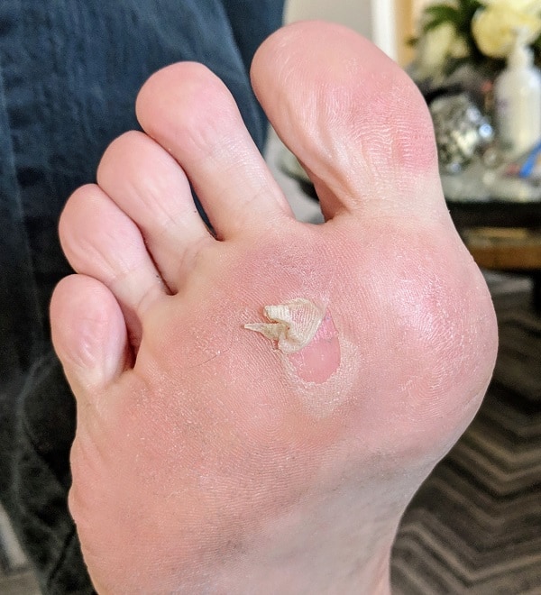 Foot blister beneath the forefoot