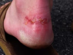 weeping foot blister at back of heel