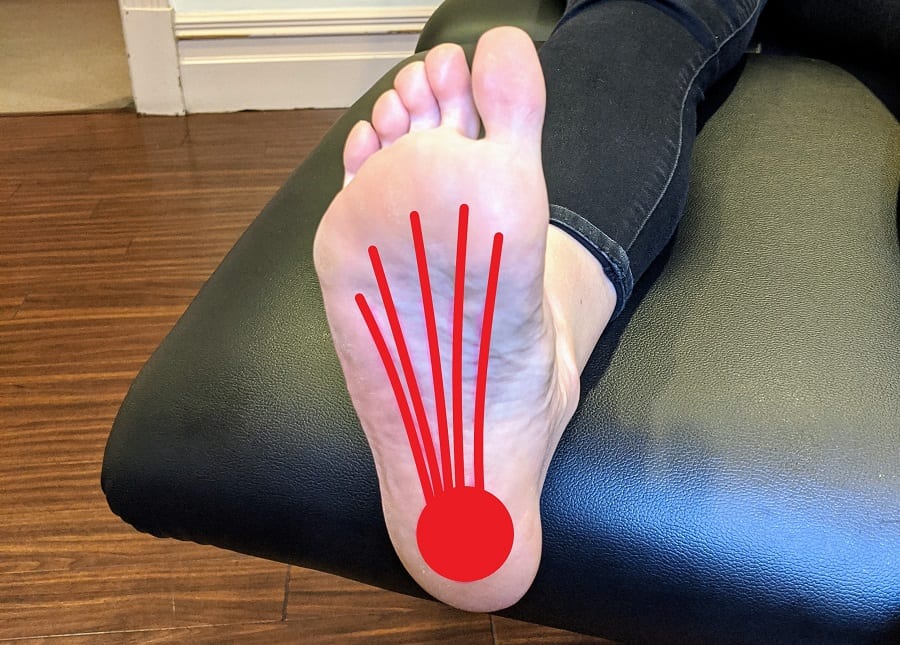 Plantar fasciitis pain sites by Posture Podiatry Adelaide