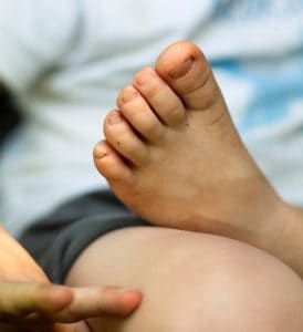 Young boys foot rests on leg with toe nails cut improperly