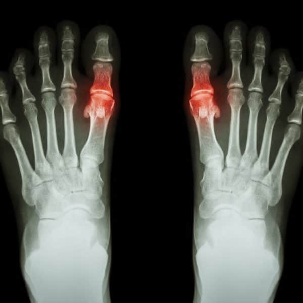 Foot Arthritis X-rays Posture Podiatry