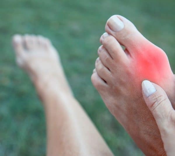 Person holding left foot with inflamed bunion near big toe joint