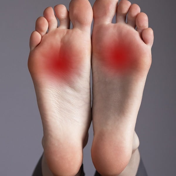 Feet with redness beneath the ball of the foot