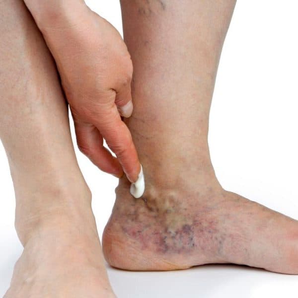 Ankle displaying varicose veins