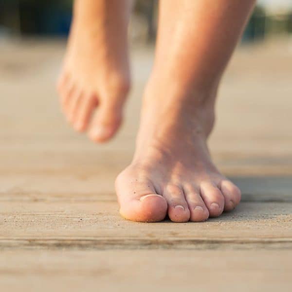 An image of a foot displaying a prominant bunion on the big toe side of the foot