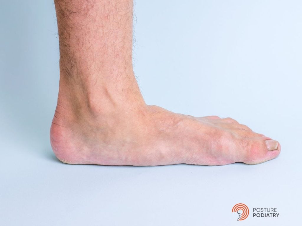 An image of a flat foot with a very low arch