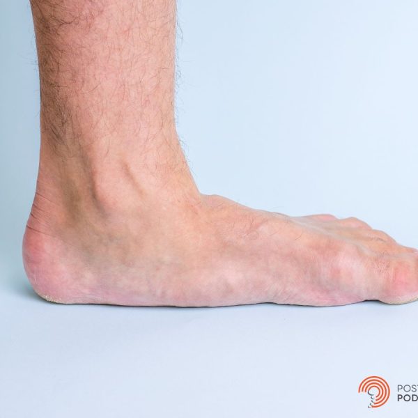 An image of a flat foot with a very low arch