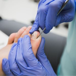 Ingrown toenail treatment