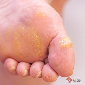 Corns and Calluses on the toes and beneath the forefoot.