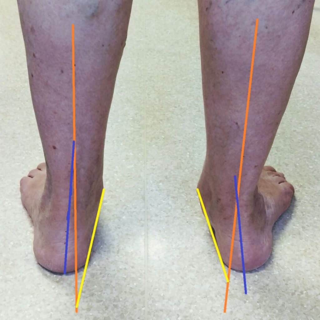 Pronated feet with right foot rolling in more than the left foot.