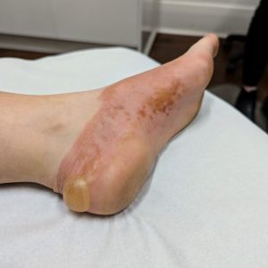 Blister on back of heel secondary to allergic skin reaction